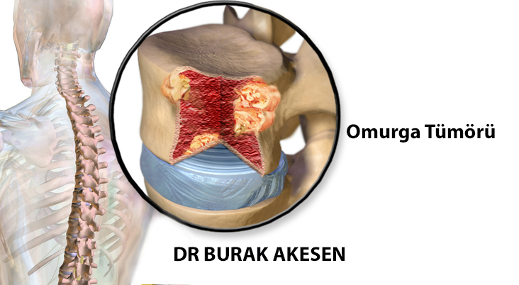 Çocuklarda Omurga Tümörleri