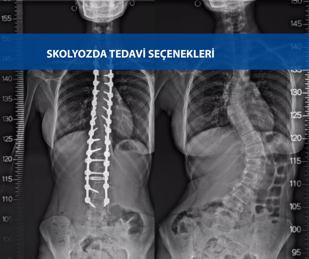 skolyozda-tedavi-secenekleri